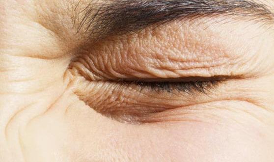 دودوئک چشم چه دلایلی دارد؟راه های درمان لرزش چشم (نیستاگموس)