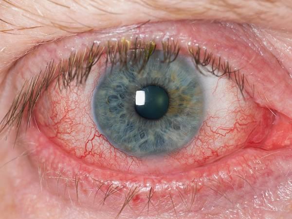 علائم بلفاریت چشم چیست؟