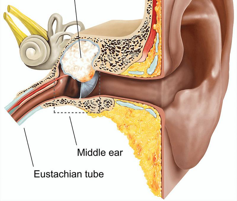 علل ابتلا به کلستئاتوم گوش را بهتر بشناسید
