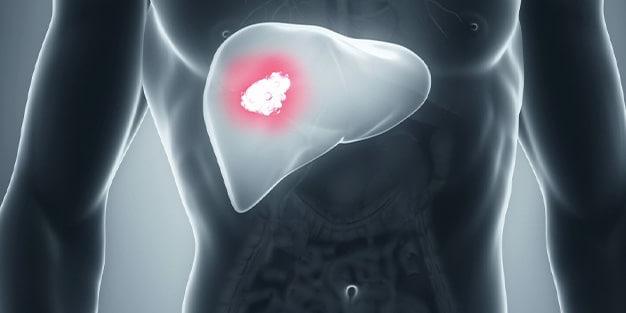 علائم و نشانه های سرطان کبد چیست؟